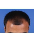 Before Hair Transplant&nbsp;Front